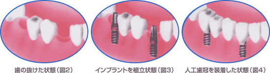 インプラント図解 - 図2：歯の抜けた状態／図3：インプラントを植立状態／図4：人口歯冠を装着した状態