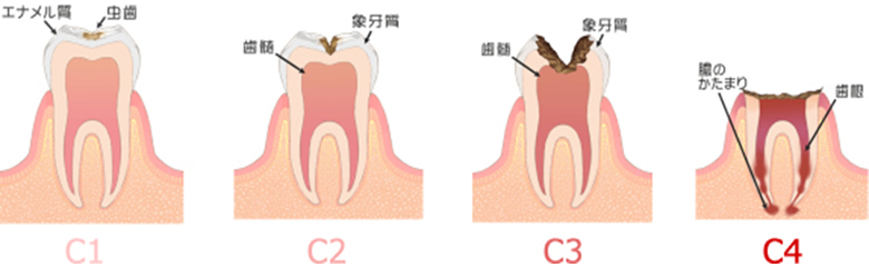 1. むし歯治療