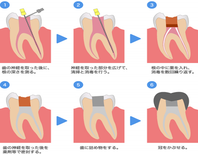 2. 根管治療