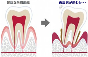 3. 歯周病治療