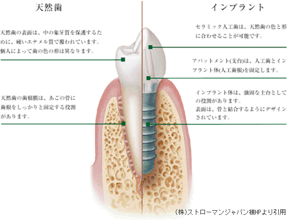 5. インプラント治療